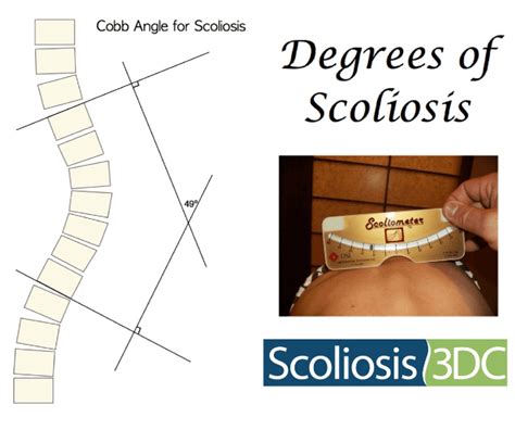 cobb test scoliosis|cobb angle for scoliosis surgery.